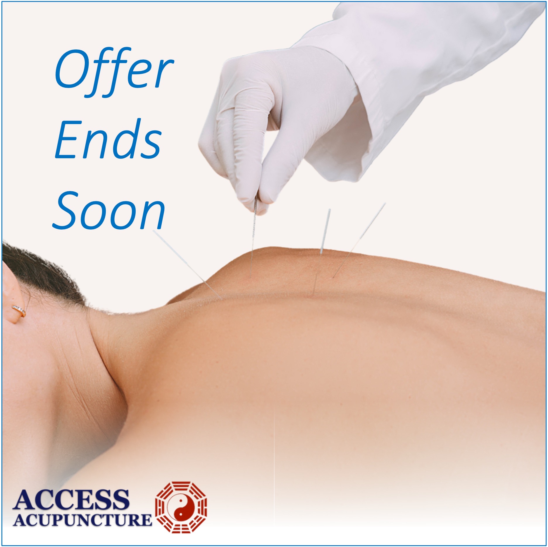 vStore Access Acupuncture Offer Ends Soon image